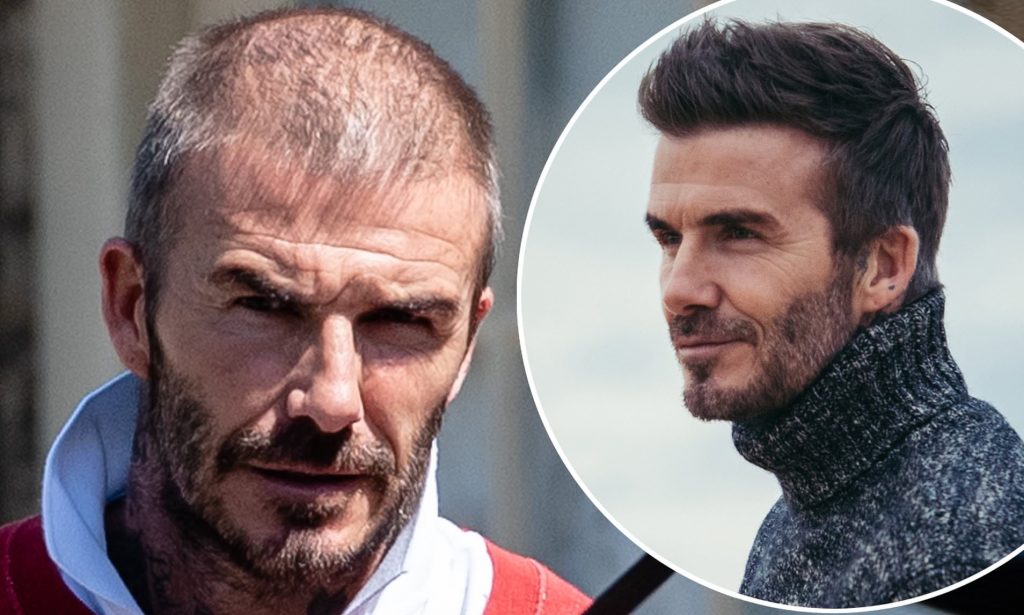 David Beckham did hair transplant in 2018. (Credit: The Daily Mail)