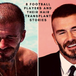 Here is the list of 8 Football Players And Their Hair Transplant Stories. (Credit: remedyistanbul.com)