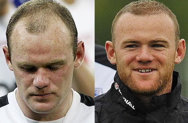 Wayne Rooney before and after his hair transplant. (Credit: The Sun)